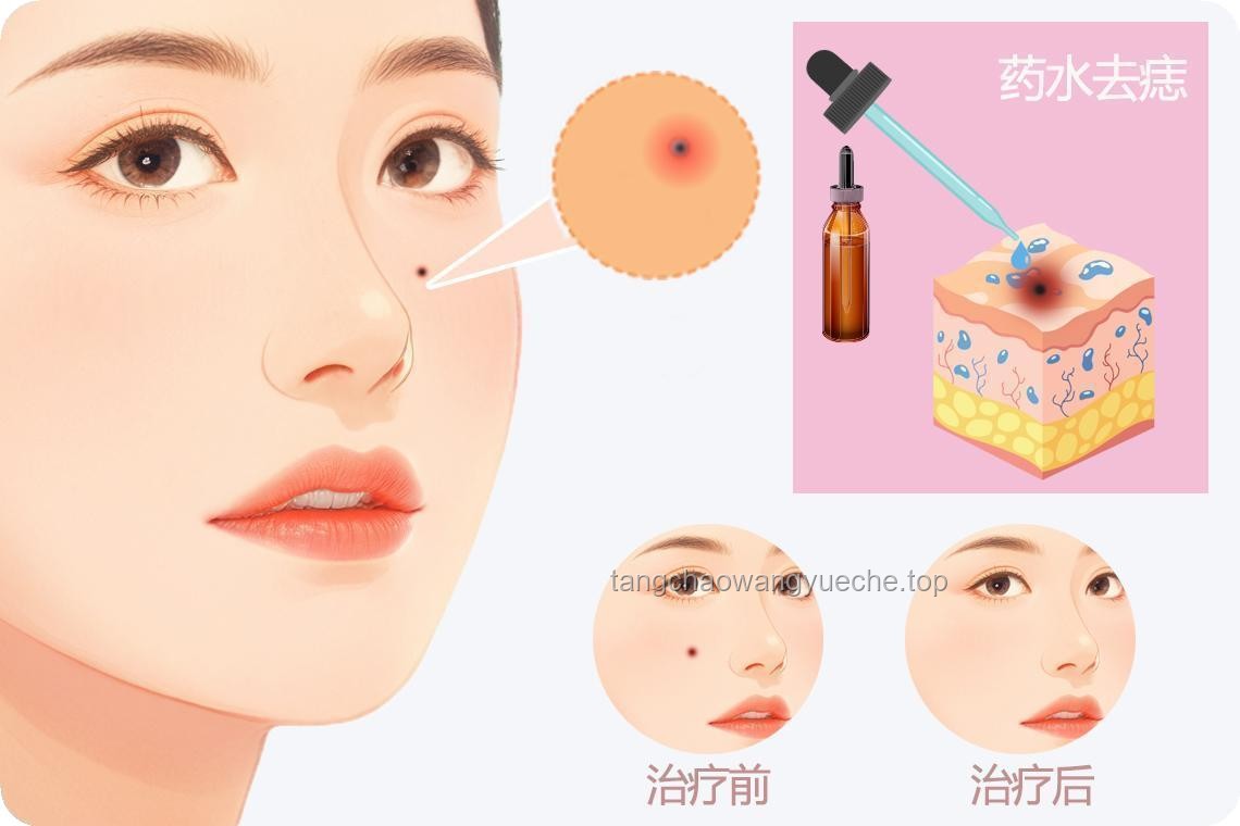 **女子右眼狂飙泪背后的真相：泪囊瘤与非病理流泪的对比分析**